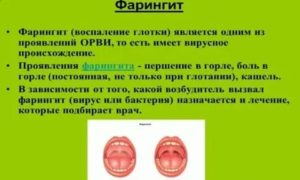Першит в горле, хронический фарингит