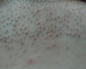 Красные точки на головке после полового акта