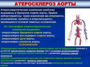 Склероз аорты. ИКС