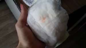 Красное пятно на памперсе