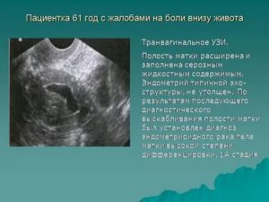 Результат узи малого таза и боли низа живота