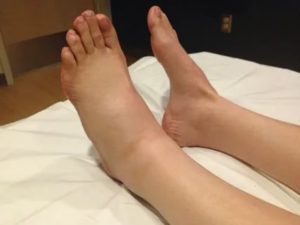 Опухла нога