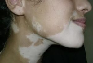 Белые пятна после прыщей не загорают