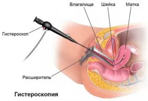 Рецидив полипа цк