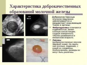 Образования в молочных железах
