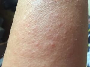 Сыпь красная на коже ступни сверху - зудит
