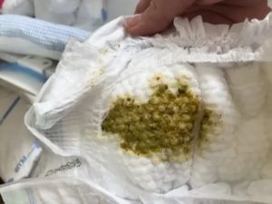 Понос у грудинка после смены смеси