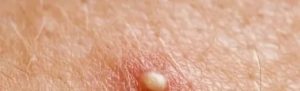 Прыщи красного цвета на мошонке и члене