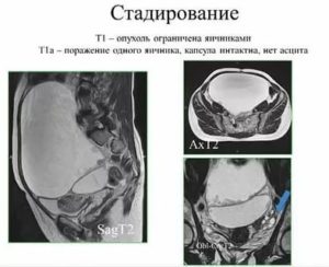 Капсула яичника 1-2 мм