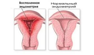 Гипоплазия эндометрия
