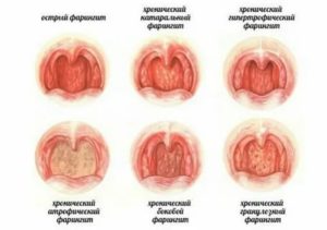 Першит в горле, хронический фарингит