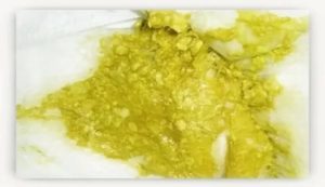 Колики, зеленый стул с белыми комочкам