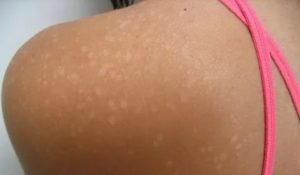 Белые пятна после прыщей не загорают