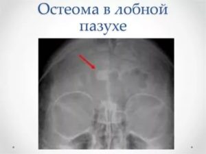Остеома лобной пазухи
