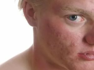 Не проходят покраснения на лице в течении пол года