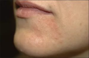 Краснота, зуд, шелушение, мелкие высыпания в виде прыщей на подбородке