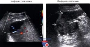 Образование селезенки