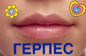 Герпес каждый месяц