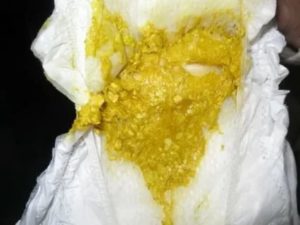 Колики, зеленый стул с белыми комочкам