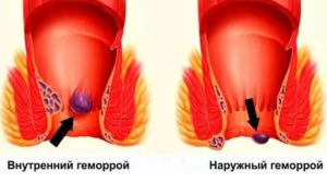 Некроз гемороидального узла
