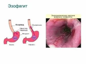 Гастроэзофагеальная рефлюксная болезнь. Дистальный эрозивный рефлюкс-эзофагит Поверхностный гастр. Ду