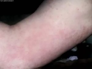 Сыпь на ноге и руке, чешется