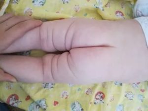 Не симметричные складки на попе