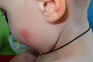 Красное пятно на щеке у ребенка
