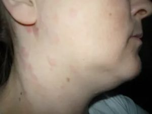 Сыпь на шее и руках