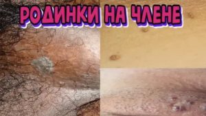 Родинка на головке полового члена