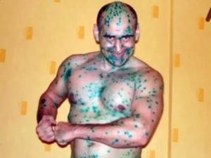 При ветрянке покраснел писюн