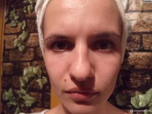 Припухлость на лбу