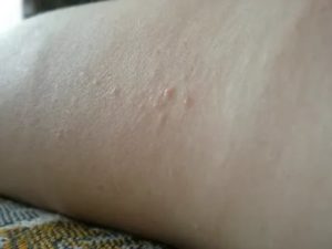 Сыпь у ребёнка телесного цвета