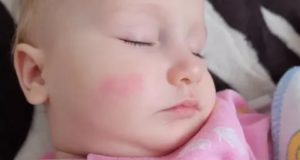 Красное пятно на щеке у ребенка