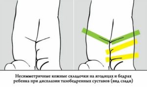 Не симметричные складки на попе
