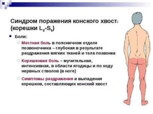 "Синдром ""конского хвоста"""