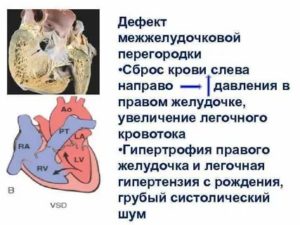 ООО со сбросом крови слева направо?