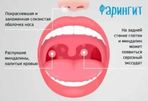 Першит в горле, хронический фарингит