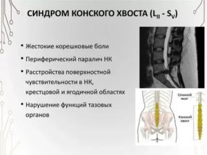 "Синдром ""конского хвоста"""