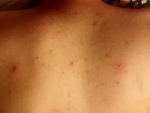 Прыщи на груди и спине на отмене преднизолона
