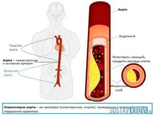 Склероз аорты. ИКС