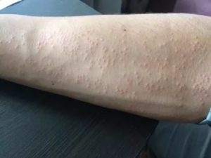 Сыпь на ноге и руке, чешется
