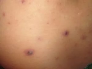 Прыщи на груди и спине на отмене преднизолона
