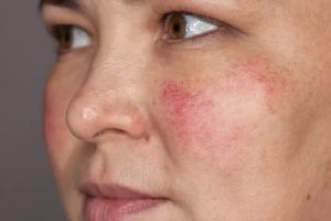 Не проходят покраснения на лице в течении пол года