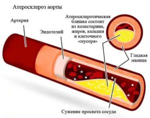 Склероз аорты. ИКС