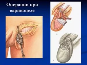 Снятие швов с мошонки