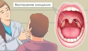 После приема антибиотиков все еще красное горло и увеличились лимфоузлы