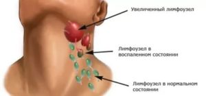 После приема антибиотиков все еще красное горло и увеличились лимфоузлы