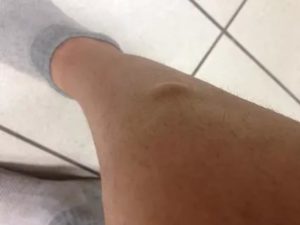 Уплотнение в голени