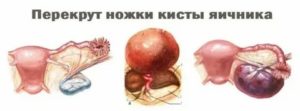 Сильная боль в левом яичнике, хотя овуляция в правом